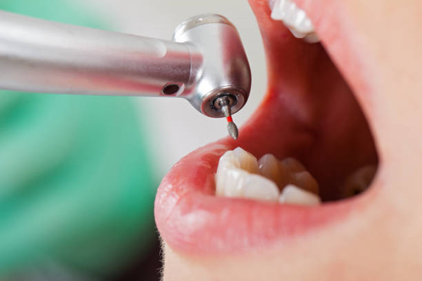Best Knocked-Out Tooth (Avulsed Tooth) Treatment in Ben Avon, SC